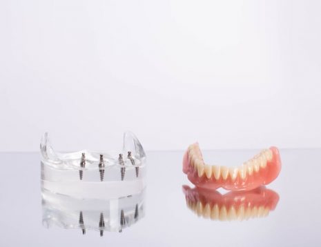 Why Choose Dental Implants Over Removable Prosthetics?