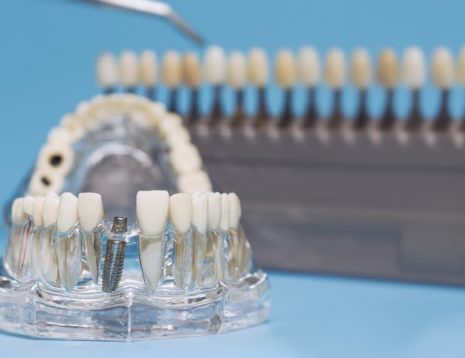 Dental Implants for People With Medical Conditions