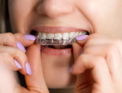 How Angel Aligners Work for Teeth Straightening