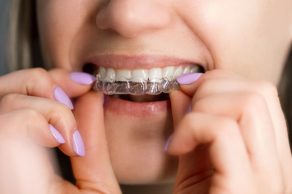 Angel Aligners